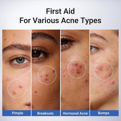 Drying Lotion for Pimple & Body Acne | Visibly Shrinks Pimples in 24 Hours & Helps Fade Acne Marks in 7 Days | 1.8% Salicylic Acid, 10% Sulfur & 4% Niacinamide | 20ml