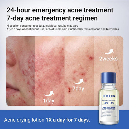 Drying Lotion for Pimple & Body Acne | Visibly Shrinks Pimples in 24 Hours & Helps Fade Acne Marks in 7 Days | 1.8% Salicylic Acid, 10% Sulfur & 4% Niacinamide | 20ml