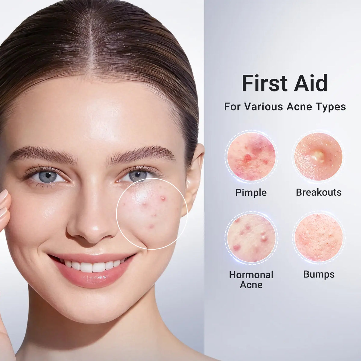 Drying Lotion for Pimple & Body Acne | Visibly Shrinks Pimples in 24 Hours & Helps Fade Acne Marks in 7 Days | 1.8% Salicylic Acid, 10% Sulfur & 4% Niacinamide | 20ml