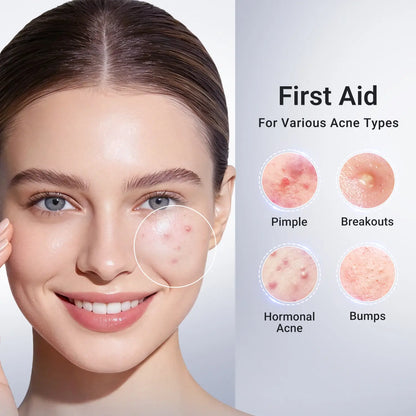 Drying Lotion for Pimple & Body Acne | Visibly Shrinks Pimples in 24 Hours & Helps Fade Acne Marks in 7 Days | 1.8% Salicylic Acid, 10% Sulfur & 4% Niacinamide | 20ml