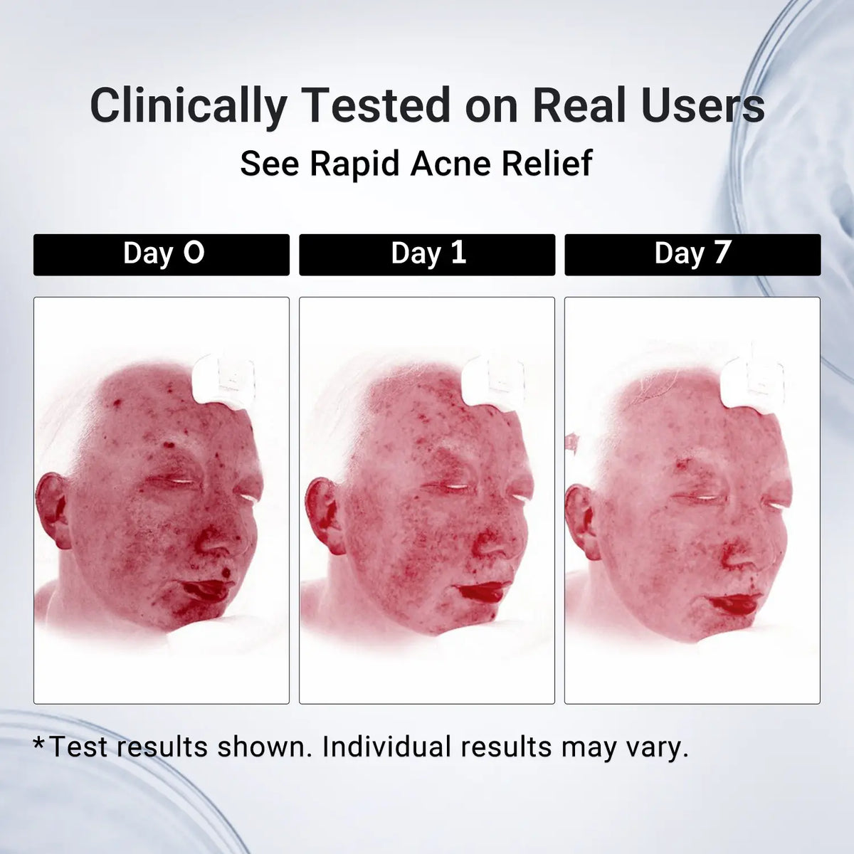 Drying Lotion for Pimple & Body Acne | Visibly Shrinks Pimples in 24 Hours & Helps Fade Acne Marks in 7 Days | 1.8% Salicylic Acid, 10% Sulfur & 4% Niacinamide | 20ml