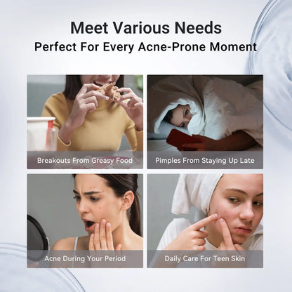 Drying Lotion for Pimple & Body Acne | Visibly Shrinks Pimples in 24 Hours & Helps Fade Acne Marks in 7 Days | 1.8% Salicylic Acid, 10% Sulfur & 4% Niacinamide | 20ml
